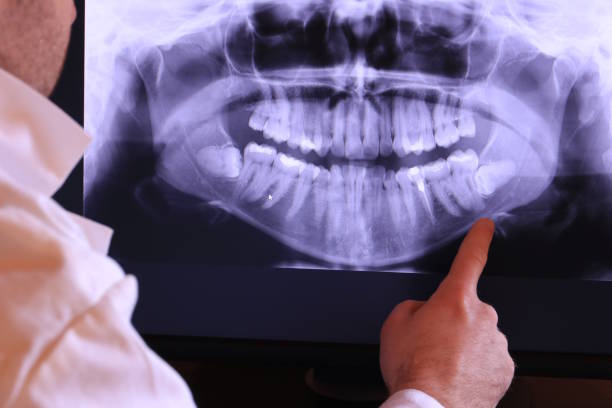 Best Emergency Root Canal Treatment in Morrisonvle, IL