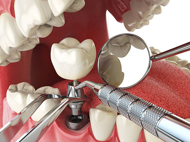 Best Emergency Dentist for Knocked-Out Tooth in Morrisonvle, IL